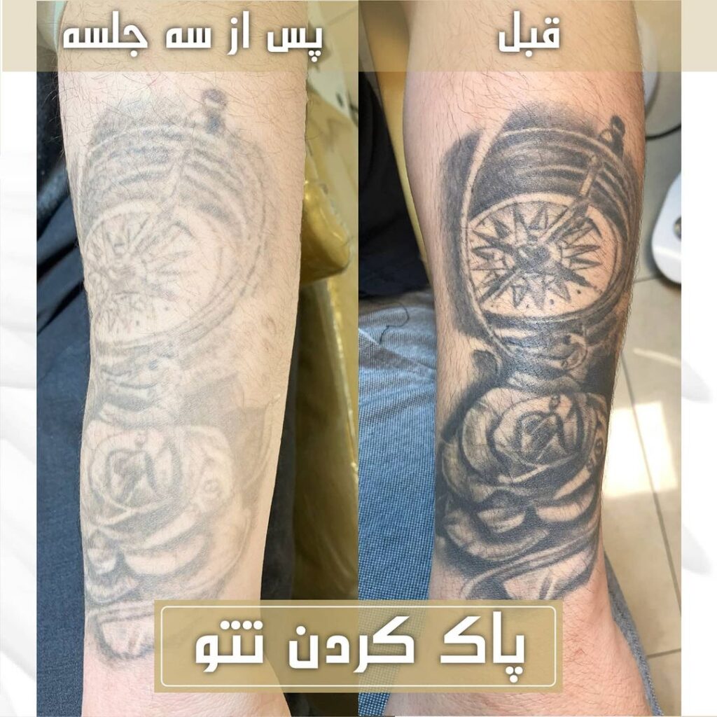 لیزر کیوسوییچ