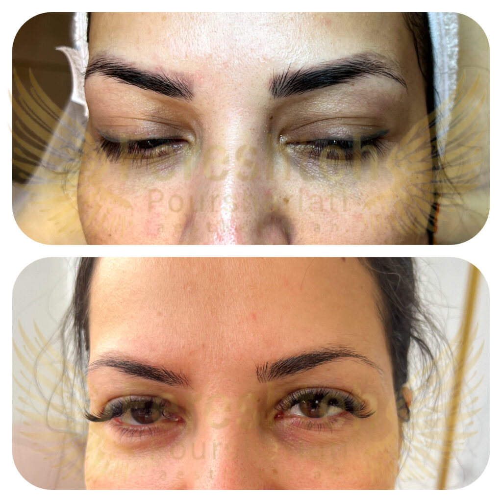 پاک کردن تتو با لیزر