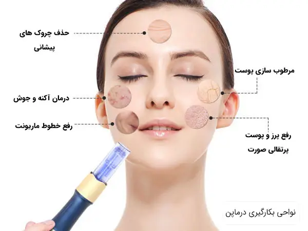 میکرونیدلینگ